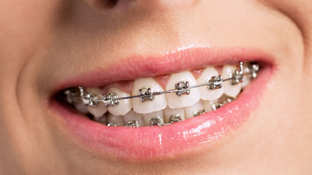 นอนกัดฟัน