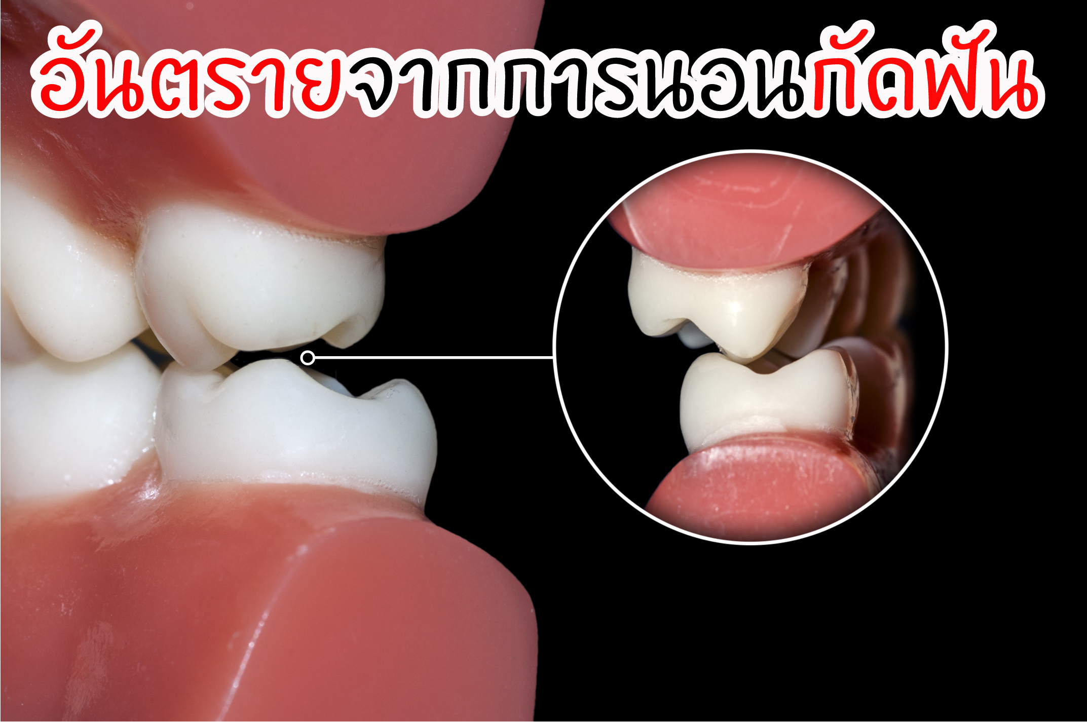 นอนกัดฟัน แก้ยังไง สาเหตุและการป้องกันอันตรายที่เกิดจากการ “นอนกัดฟัน”